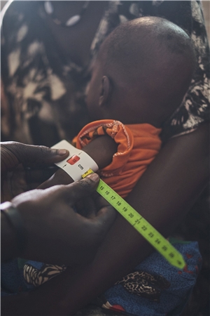 Südsudan: Hunger Unterernährtes Kind im Krankenhaus